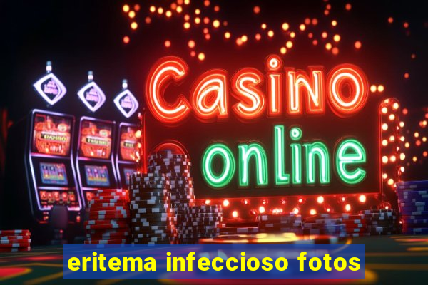 eritema infeccioso fotos